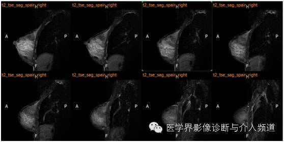 【病例】乳腺癌1例MR影像表现