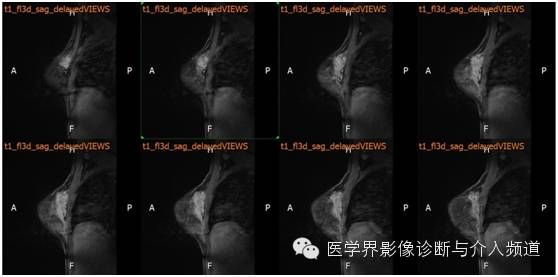 【病例】乳腺癌1例MR影像表现