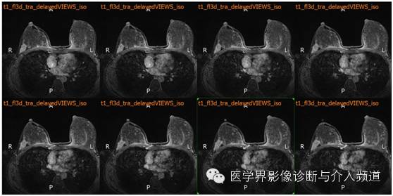 【病例】乳腺癌1例MR影像表现