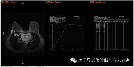 【病例】乳腺癌1例MR影像表现