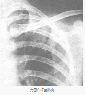 八种常见肺炎的X线诊断