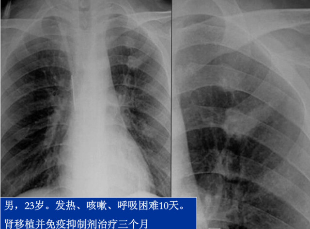 八种常见肺炎的X线诊断