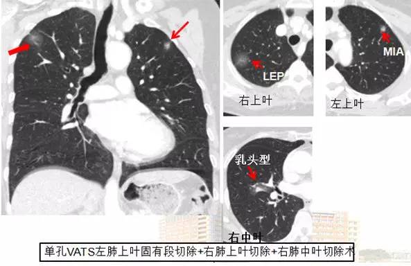 肺部毛玻璃样变=肺癌？一文解析你不知道的 GGO