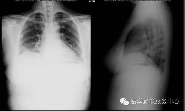 【病例】右下肺乳头状腺癌1例CT影像表现
