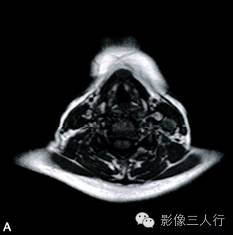 【病例】异位淋巴瘤性甲状腺肿1例MR影像表现分析
