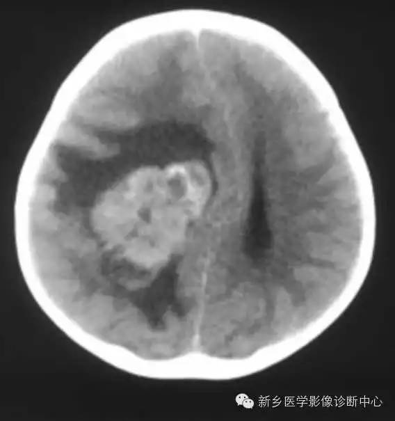 【病例】血管周围细胞瘤1例CT MR影像表现