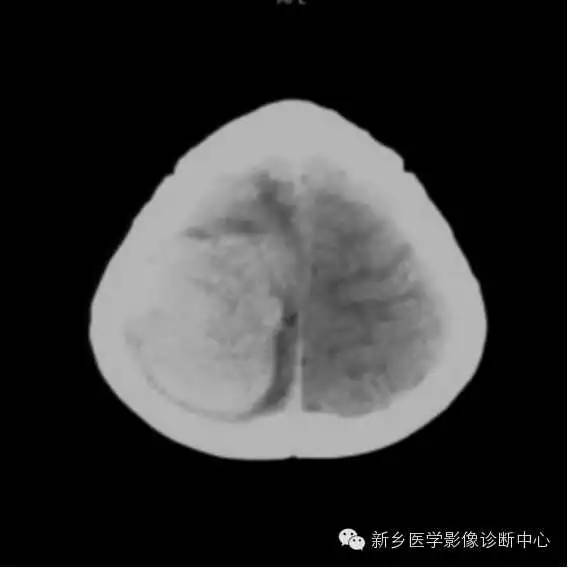【病例】血管周围细胞瘤1例CT MR影像表现