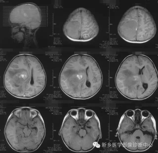 【病例】血管周围细胞瘤1例CT MR影像表现