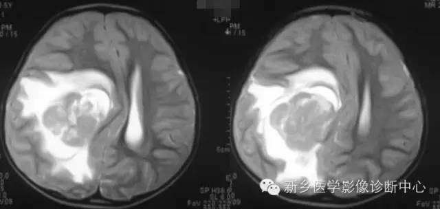 【病例】血管周围细胞瘤1例CT MR影像表现