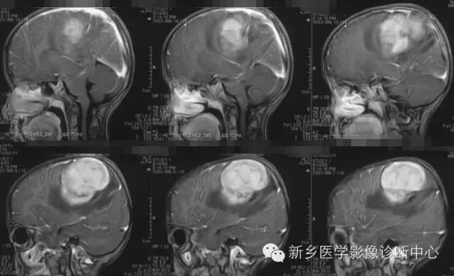【病例】血管周围细胞瘤1例CT MR影像表现