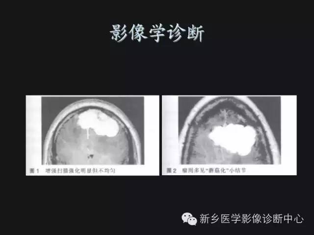 【病例】血管周围细胞瘤1例CT MR影像表现