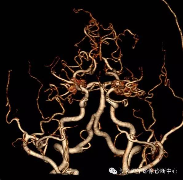烟雾病的分型和分期