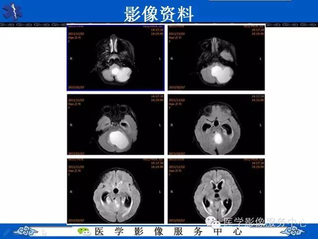 【病例】毛细胞型星形细胞瘤1例MR影像表现