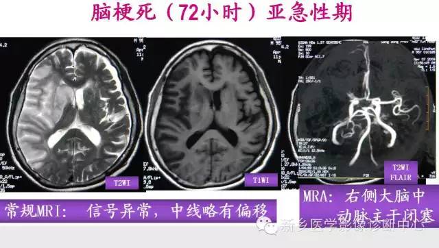 脑梗塞的磁共振分期图解
