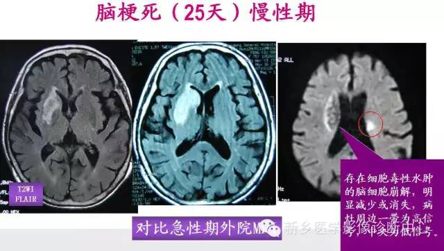 脑梗塞的磁共振分期图解