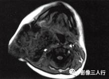 【病例】颈部淋巴管瘤1例MR影像表现分析