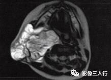【病例】颈部淋巴管瘤1例MR影像表现分析