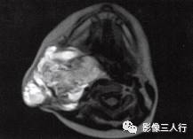 【病例】颈部淋巴管瘤1例MR影像表现分析