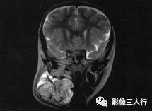 【病例】颈部淋巴管瘤1例MR影像表现分析