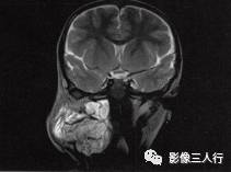 【病例】颈部淋巴管瘤1例MR影像表现分析