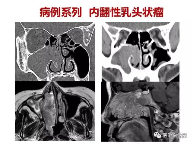 【PPT】鼻腔鼻窦肿瘤与肿瘤样病变的影像学诊断分析思路