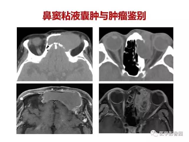 【PPT】鼻腔鼻窦肿瘤与肿瘤样病变的影像学诊断分析思路