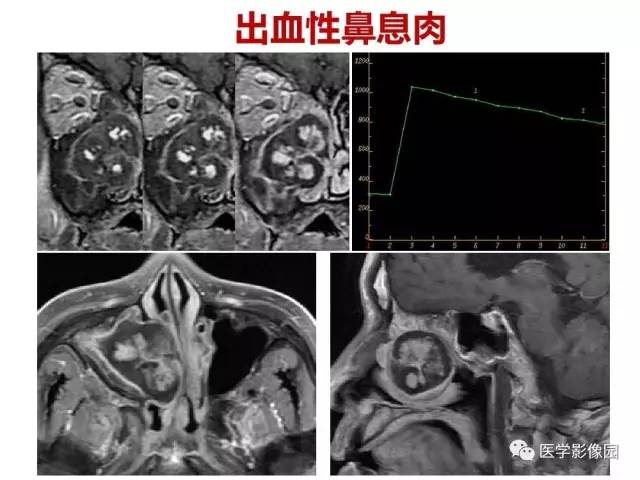 【PPT】鼻腔鼻窦肿瘤与肿瘤样病变的影像学诊断分析思路