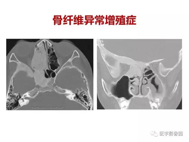【PPT】鼻腔鼻窦肿瘤与肿瘤样病变的影像学诊断分析思路
