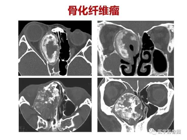 【PPT】鼻腔鼻窦肿瘤与肿瘤样病变的影像学诊断分析思路