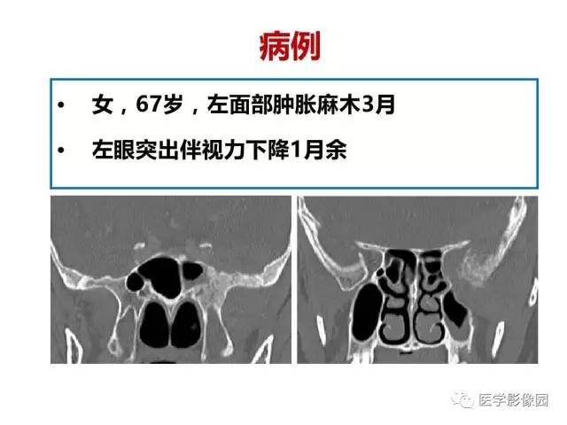 【PPT】鼻腔鼻窦肿瘤与肿瘤样病变的影像学诊断分析思路