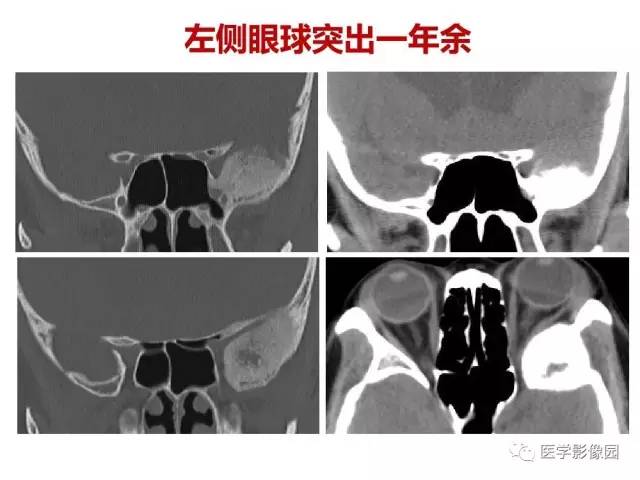 【PPT】鼻腔鼻窦肿瘤与肿瘤样病变的影像学诊断分析思路