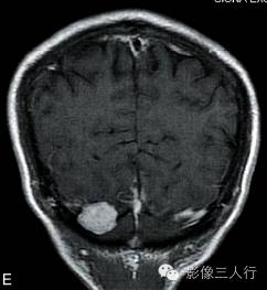 【病例】颅内血管平滑肌瘤1例MR影像表现