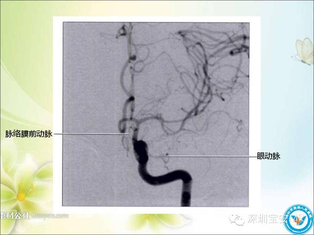 【PPT】颈内动脉颅内段影像解剖(附临床血管病例)