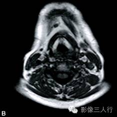 【病例】异位淋巴瘤性甲状腺肿1例MR影像表现分析