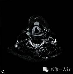 【病例】异位淋巴瘤性甲状腺肿1例MR影像表现分析
