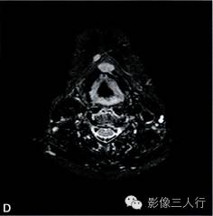 【病例】异位淋巴瘤性甲状腺肿1例MR影像表现分析