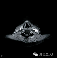 【病例】异位淋巴瘤性甲状腺肿1例MR影像表现分析