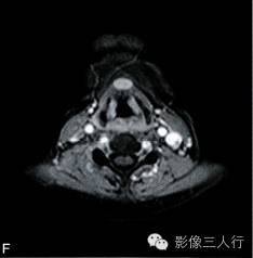 【病例】异位淋巴瘤性甲状腺肿1例MR影像表现分析