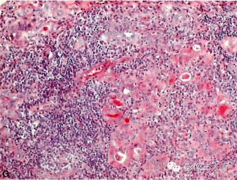 【病例】异位淋巴瘤性甲状腺肿1例MR影像表现分析