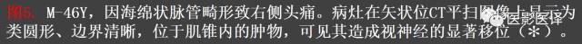 成人眼眶肿瘤：临床、影像、与病理回顾
