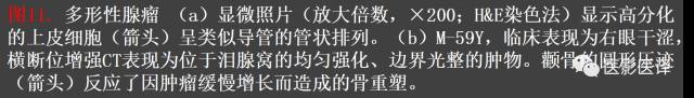 成人眼眶肿瘤：临床、影像、与病理回顾