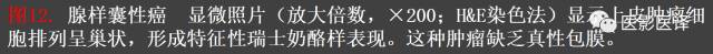 成人眼眶肿瘤：临床、影像、与病理回顾