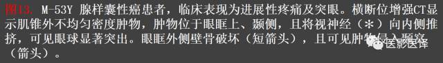 成人眼眶肿瘤：临床、影像、与病理回顾
