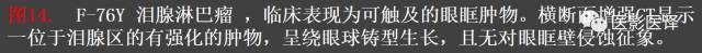 成人眼眶肿瘤：临床、影像、与病理回顾