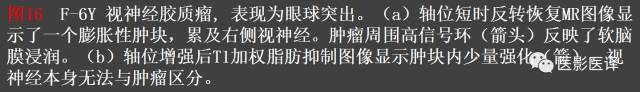 成人眼眶肿瘤：临床、影像、与病理回顾