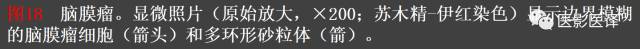 成人眼眶肿瘤：临床、影像、与病理回顾