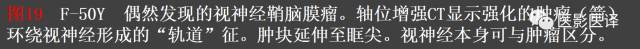 成人眼眶肿瘤：临床、影像、与病理回顾