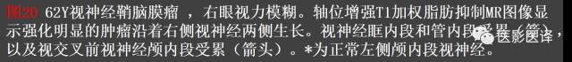 成人眼眶肿瘤：临床、影像、与病理回顾