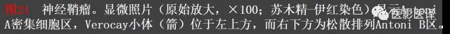 成人眼眶肿瘤：临床、影像、与病理回顾