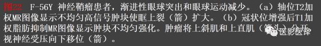 成人眼眶肿瘤：临床、影像、与病理回顾